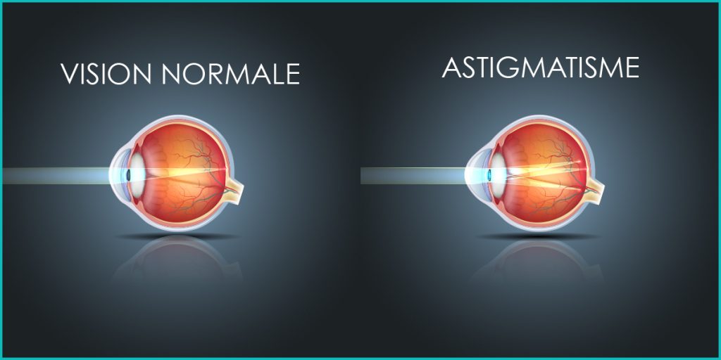 Astigmatisme Traitement de l
