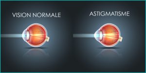 Astigmatisme-correction-laser