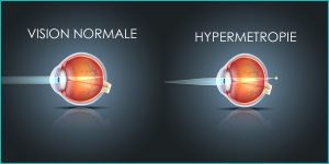 Traitement de l'hypermétropie au laser Ophtalmologie var