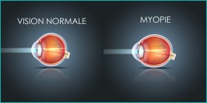 myopie correction laser